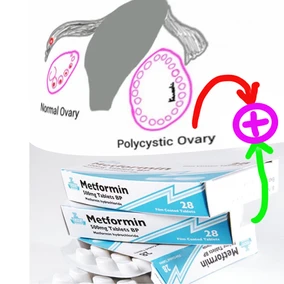I have PCOS, I have heard about Metformin use in PCOS and I’m confused….