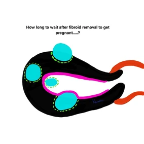 How Soon Can You Get Pregnant after a fibroid removal surgery?