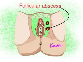 Recurrent Vaginal skin infections…. could diabetes be masquerading….?